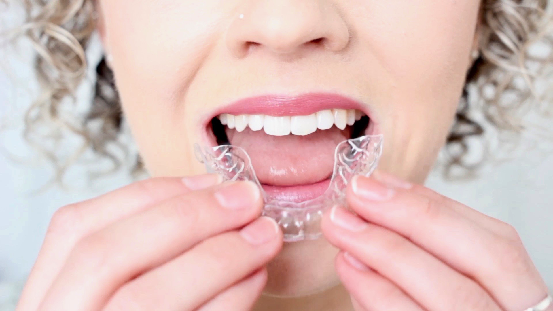 invisalign smilalign straight teeth