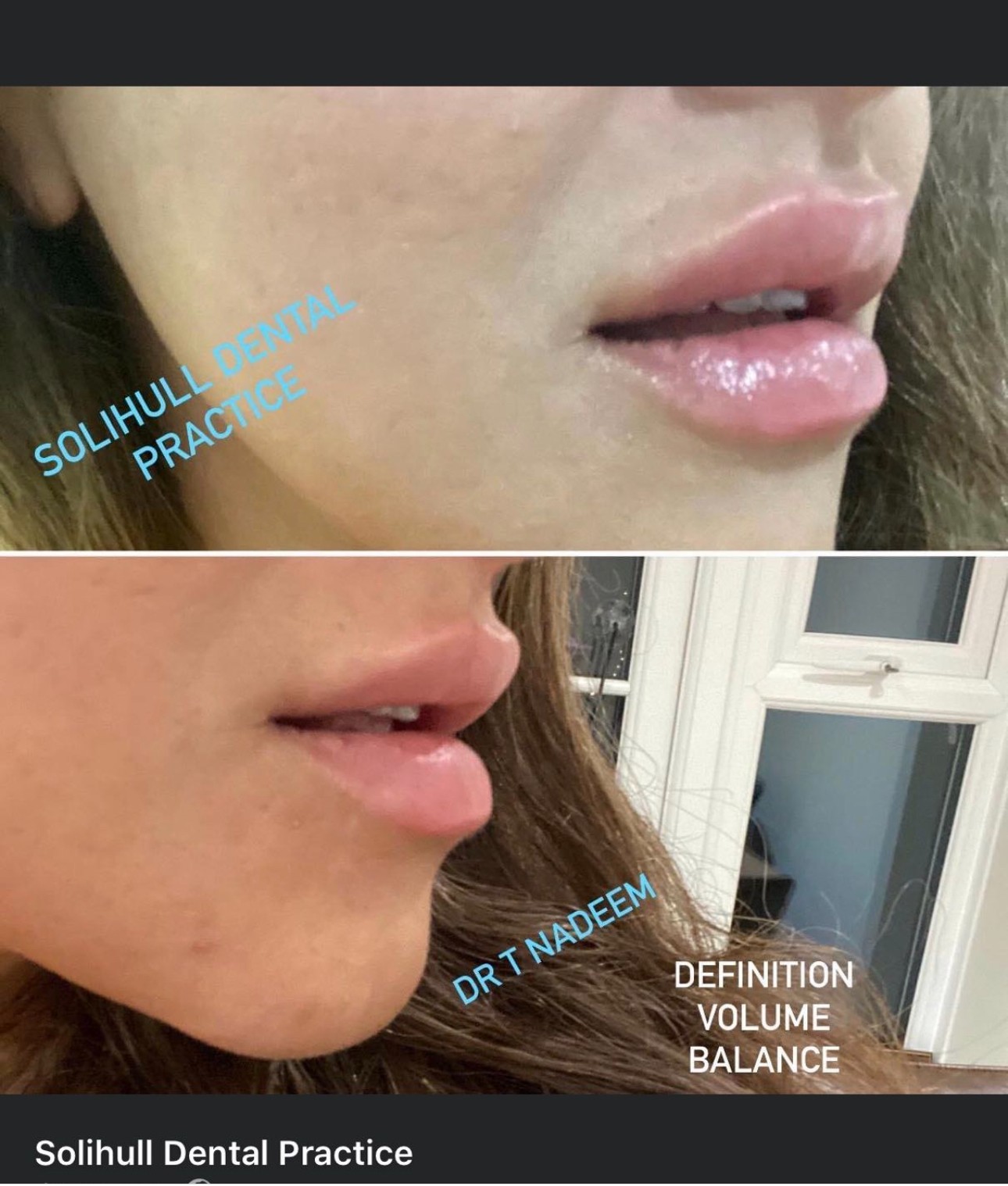 lip fillers