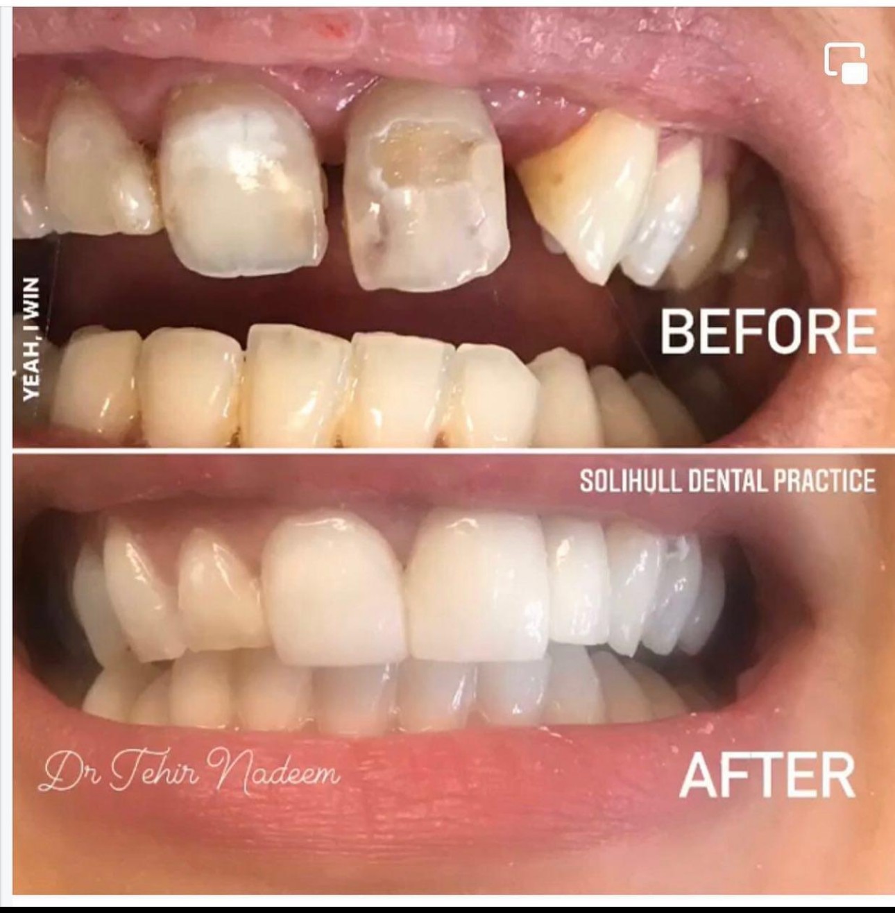 replacing missing teeth composite bonding  veneers